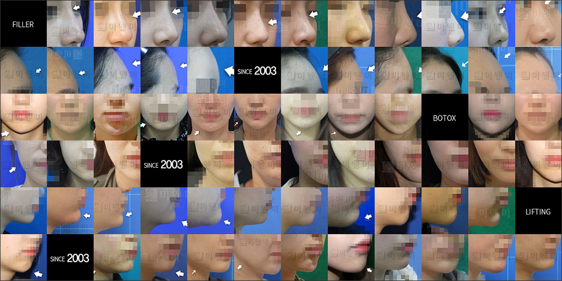 SINCE 2003 MI&MI, 시술후사진모음 수유스컬트라,수유역스컬트라